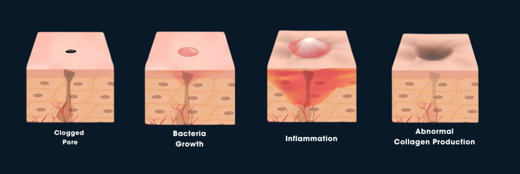 Acne Scar Stages